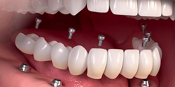 Taboola Ad Example 18344 - Here's How Much Dental Implants Should Cost In London