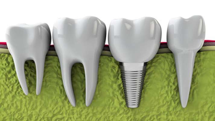 RevContent Ad Example 55529 - See What Full Mouth Dental Implants Should Cost
