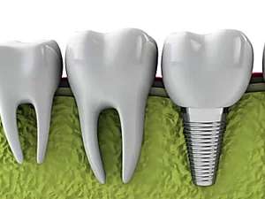 Outbrain Ad Example 35926 - Here's What New Dental Implants Should Cost You In 2020!