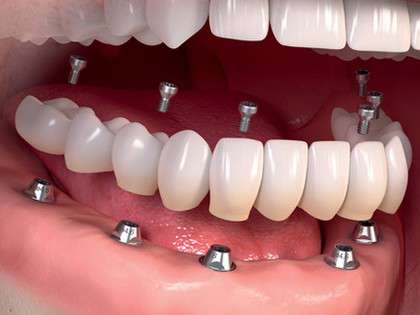 RevContent Ad Example 60865 - Here's How Much Dental Implants Should Cost You