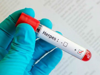 RevContent Ad Example 17198 - How To: Get 'rid' Of Herpes For Good - Try It Today