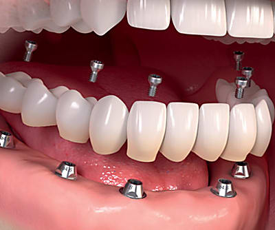 Taboola Ad Example 17230 - Dental Implants | Sponsored Links