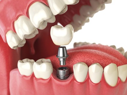 RevContent Ad Example 17901 - Here's How Much New Dental Implants Should Cost You