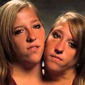 Outbrain Ad Example 44850 - [Photos] Siamese Twins Are 27 Years Old - And Make A Life-Changing Decision