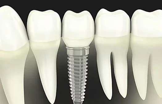 Outbrain Ad Example 41492 - Dental Implants Cost In 2019 May Surprise You