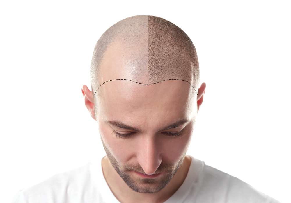Taboola Ad Example 56117 - The Cost Of Hair Transplant In Turkey May Surprise You