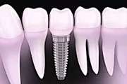 Outbrain Ad Example 31910 - Here's What New Dental Implants Should Cost In 2020