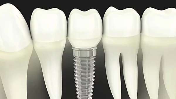 Outbrain Ad Example 57983 - Here's What New Dental Implants Should Cost In 2019