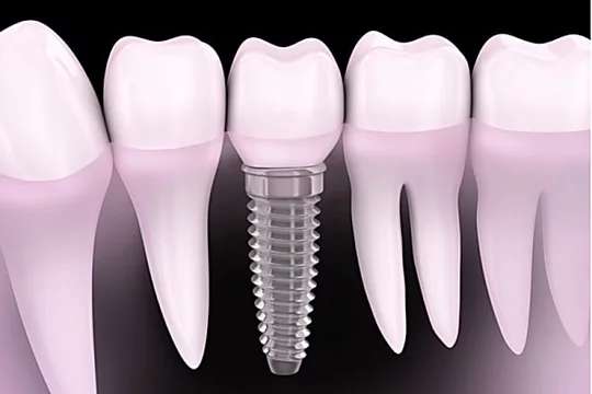 Outbrain Ad Example 43325 - Here Is What Full Mouth Dental Implants Should Cost You In 2019