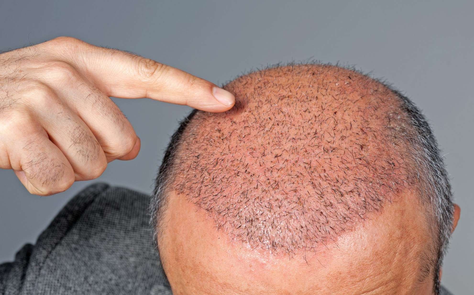 Taboola Ad Example 54489 - The Cost Of Hair Transplant In Turkey Might Surprise You