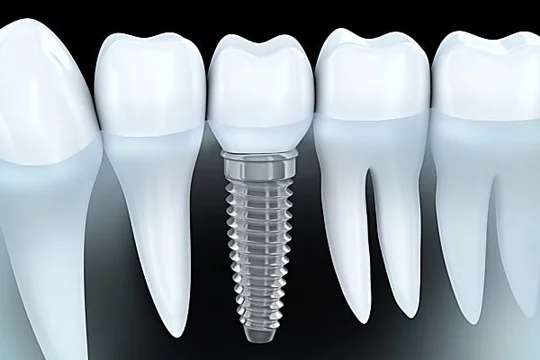 Outbrain Ad Example 43046 - Here Is What Full Mouth Dental Implants Should Cost You In 2019
