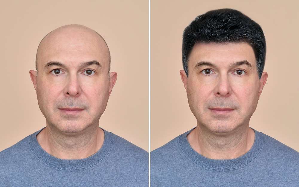 Taboola Ad Example 56072 - The Cost Of Hair Transplant In Dubai May Surprise You