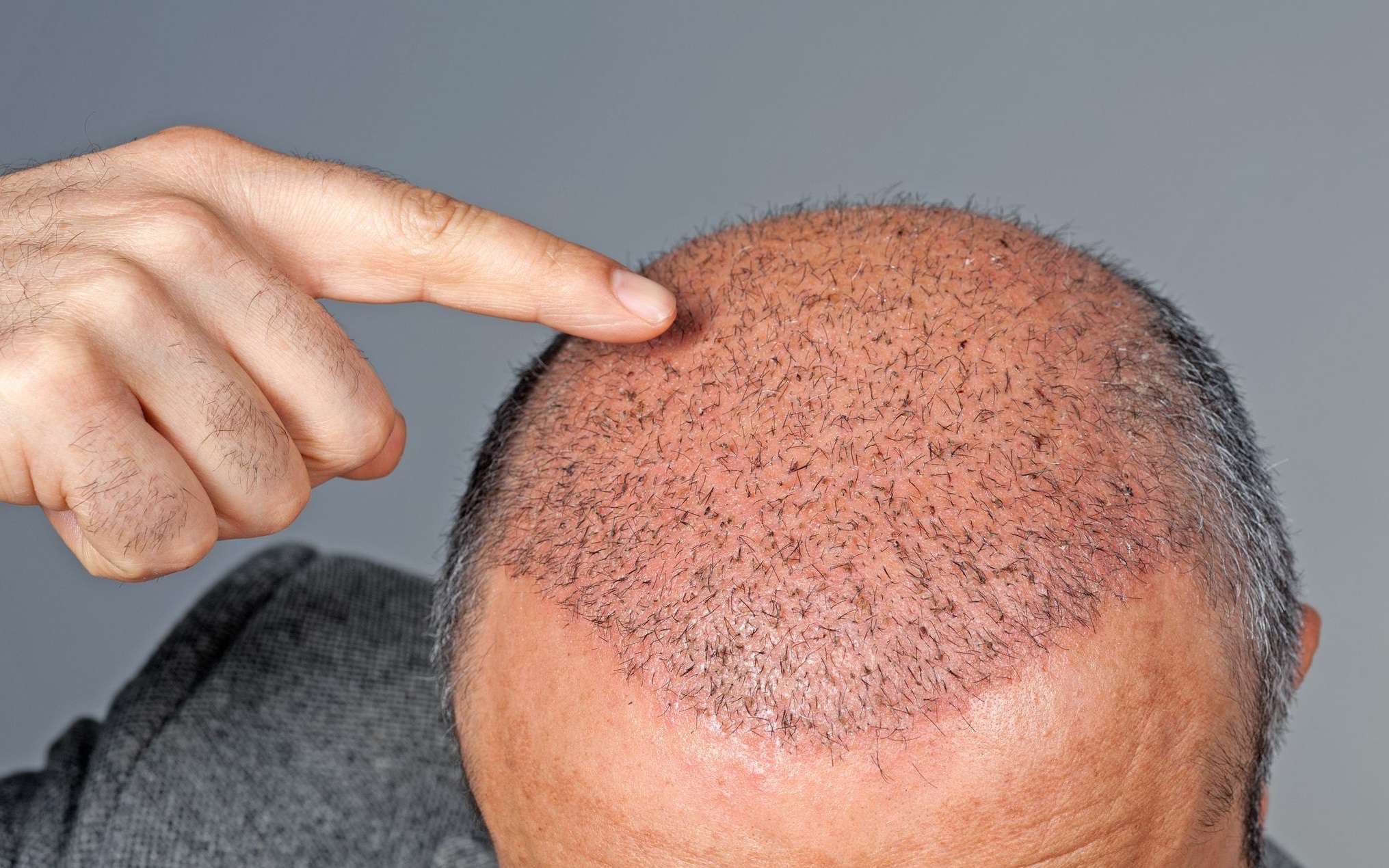 Taboola Ad Example 54488 - The Cost Of Hair Transplant In Turkey Might Surprise You