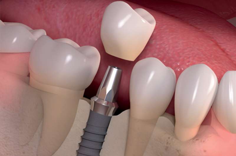 RevContent Ad Example 62933 - You Won't Believe These Prices For Dental Implants In Toronto