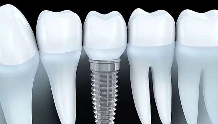 Outbrain Ad Example 41230 - Dental Implants Cost In 2019 May Surprise You