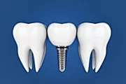 Outbrain Ad Example 31808 - Here's What New Dental Implants Should Cost In 2020
