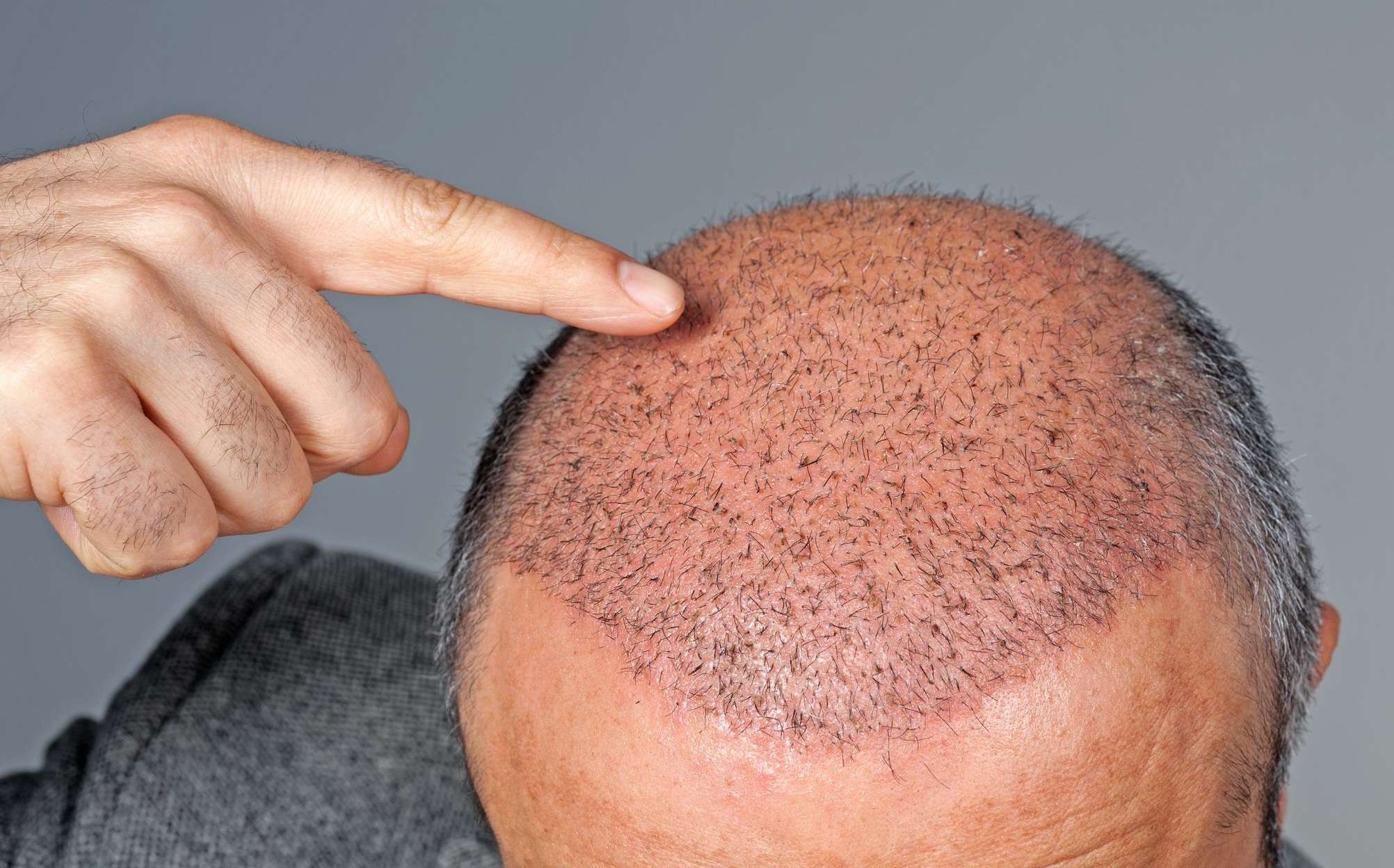 Taboola Ad Example 54491 - The Cost Of Hair Transplant In Turkey Might Surprise You
