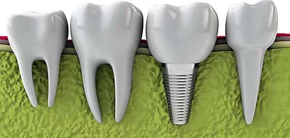 Outbrain Ad Example 57755 - Here Is What New Dental Implants Should Cost You In 2019