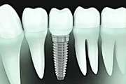 Outbrain Ad Example 30678 - Here's What New Dental Implants Should Cost In 2020