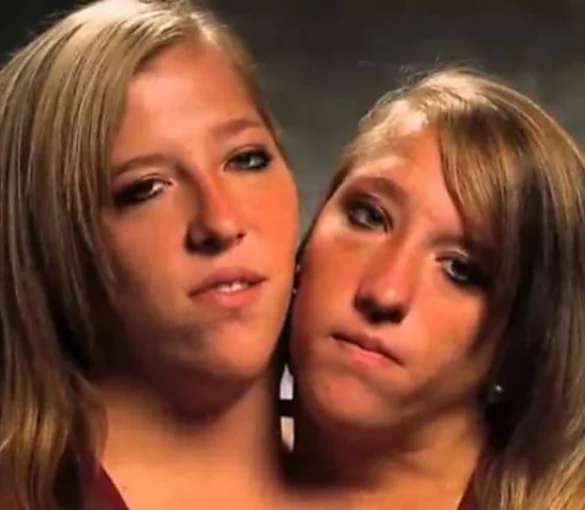 Outbrain Ad Example 44718 - [Photos] Siamese Twins Are 27 Years Old - And Make A Life-Changing Decision