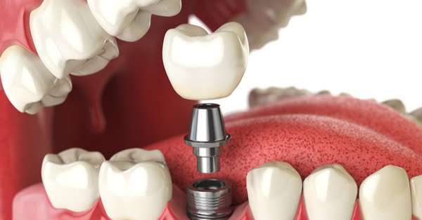 Google Ad Exchange Ad Example 37342 - Implants DentalesBaratos