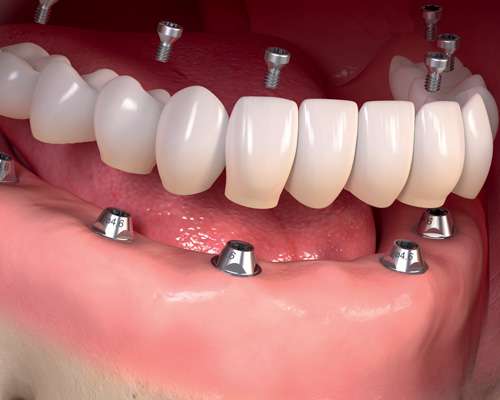 RevContent Ad Example 62812 - Here's What Dental Implants Should Cost You In Toronto