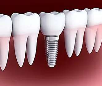 Outbrain Ad Example 33155 - Here's What New Dental Implants Should Cost In 2020
