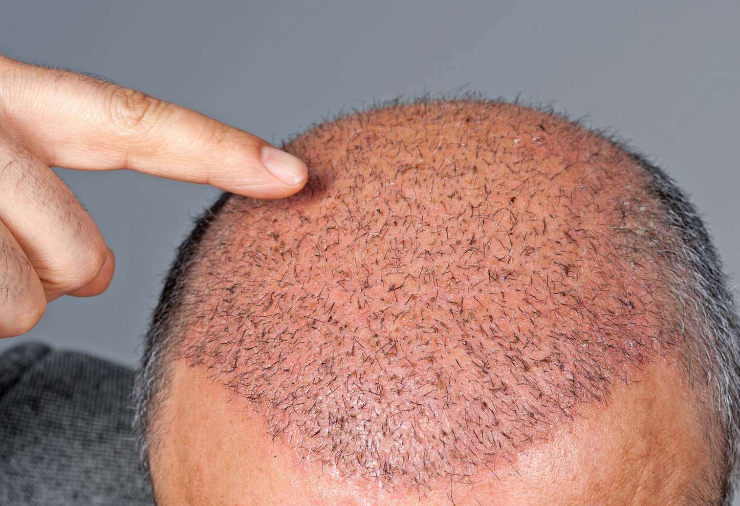 Taboola Ad Example 54769 - The Cost Of Hair Transplants In London May Surprise You