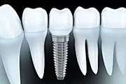 Outbrain Ad Example 30640 - Here's What New Dental Implants Should Cost In 2020
