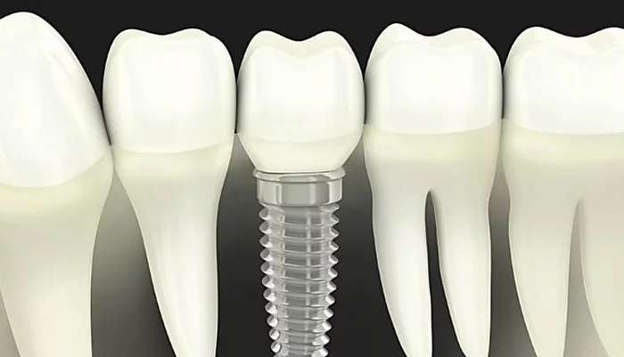 Outbrain Ad Example 57581 - Dental Implants Cost In 2019 May Surprise You