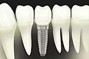 Outbrain Ad Example 31415 - Here's What New Dental Implants Should Cost In 2020