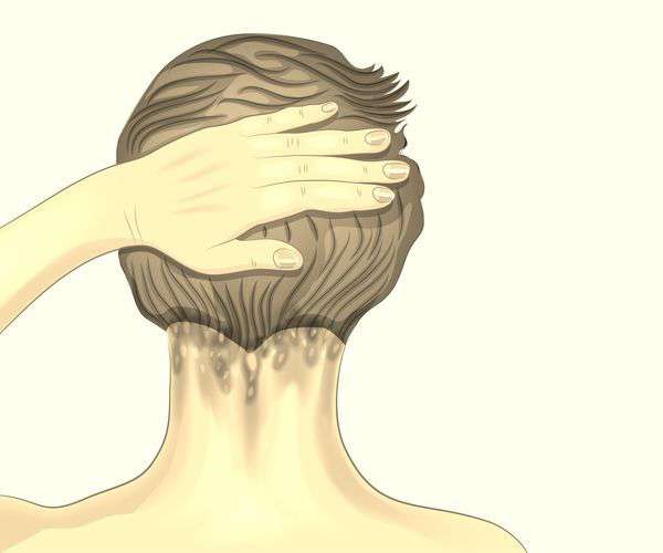 Taboola Ad Example 54203 - What Is Scalp Psoriasis? Symptoms & Treatments