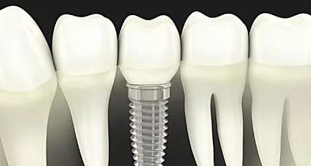 Outbrain Ad Example 39730 - Here's What New Dental Implants Should Cost In 2019