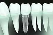 Outbrain Ad Example 41051 - Dental Implants Cost In 2019 May Surprise You
